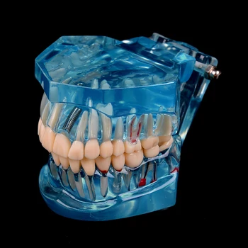 Novi Zobni Vsadki Bolezni Zob Model Z Obnovo Mostu Zob Zobozdravnik Za Medicinske Znanosti Zobne Bolezni Poučevanja, Študija