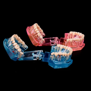 Novi Zobni Vsadki Bolezni Zob Model Z Obnovo Mostu Zob Zobozdravnik Za Medicinske Znanosti Zobne Bolezni Poučevanja, Študija
