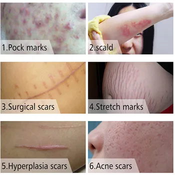 MSLAM Acne Scar Removal Cream Obraz Mozolji Strij Gel Popravilo Glajenje Vlažilne Kirurški Brazgotina Opekline Telo za Nego Kože