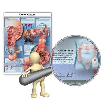 Rak debelega črevesa Grafikon Poster Tiskanje Platno Slikarstvo Stenske Slike za Medicinsko Izobraževanje Zdravnikov Urad Razredu